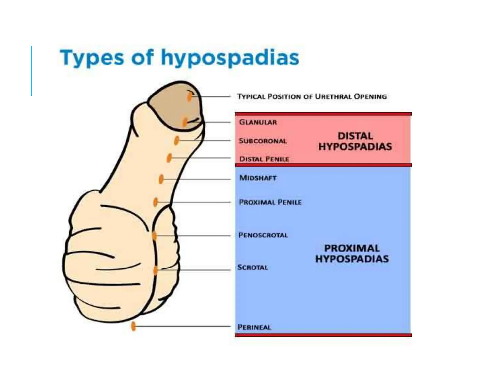 Surgical Management Of Proximal Hypospadias ppt Surgical Management Of Proximal Hypospadias ppt