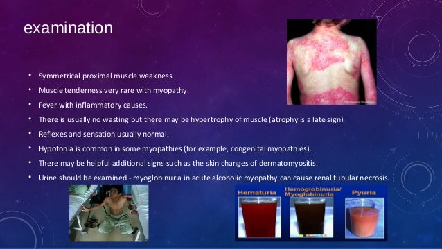 Proximal myopathy and causes