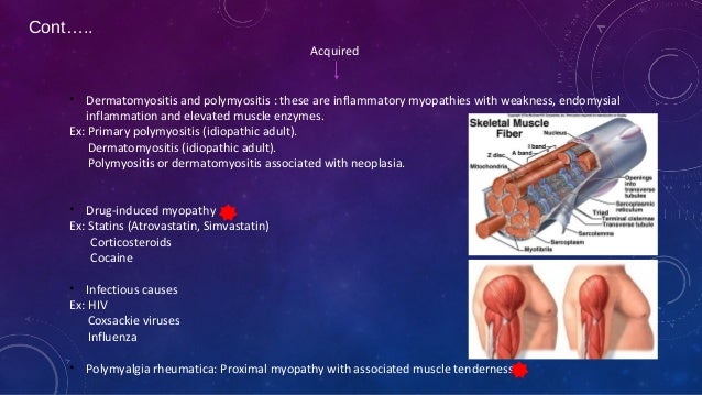 Proximal myopathy and causes Proximal myopathy and causes