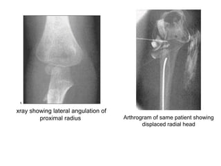 xray showing lateral angulation of
proximal radius Arthrogram of same patient showing
displaced radial head
 