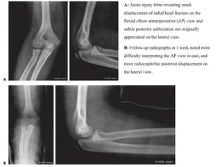 A: Acute injury films revealing small
displacement of radial head fracture on the
flexed elbow anteroposterior (AP) view and
subtle posterior subluxation not originally
appreciated on the lateral view.
B: Follow-up radiographs at 1 week noted more
difficulty interpreting the AP view in cast, and
more radiocapitellar posterior displacement on
the lateral view.
 