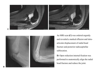 An MRI scan (C) was ordered urgently
and revealed a marked effusion and intra-
articular displacement of radial head
fracture and posterior radiocapitellar
subluxation.
D: Open reduction internal fixation was
performed to anatomically align the radial
head fracture and reduce the joint.
 