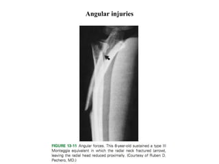 Angular injuries
 
