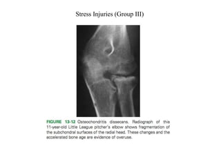 Stress Injuries (Group III)
 