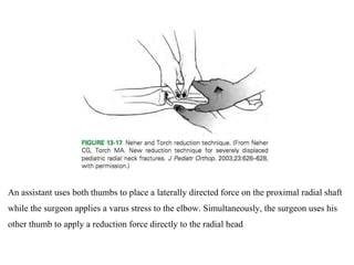 An assistant uses both thumbs to place a laterally directed force on the proximal radial shaft
while the surgeon applies a varus stress to the elbow. Simultaneously, the surgeon uses his
other thumb to apply a reduction force directly to the radial head
 
