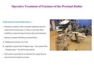 Operative Treatment of Fractures of the Proximal Radius
Indications/Contraindications :-
• Indicated in situations where acceptable alignment cannot be
achieved with closed means, or if there is persistent elbow
instability or restricted range of motion after closed treatment.
• Operative treatment should be considered when :-
A. Displacement remains over 2 mm,
B. angulation is greater than 45 degrees (age < 10) or greater than
30 degrees (age > 10), and for open injuries.
• Nerve palsy is generally not an indication for surgery because
most will recover function over time.
 