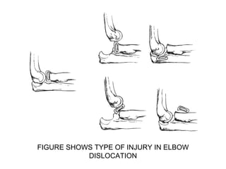 FIGURE SHOWS TYPE OF INJURY IN ELBOW
DISLOCATION
 