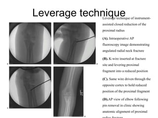 Leverage techniqueLeverage technique of instrument-
assisted closed reduction of the
proximal radius
(A). Intraoperative AP
fluoroscopy image demonstrating
angulated radial neck fracture
(B). K-wire inserted at fracture
site and levering proximal
fragment into a reduced position
(C). Same wire driven through the
opposite cortex to hold reduced
position of the proximal fragment
(D).AP view of elbow following
pin removal in clinic showing
anatomic alignment of proximal
 