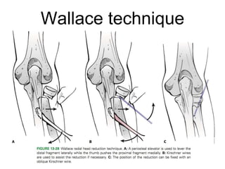 Wallace technique
 