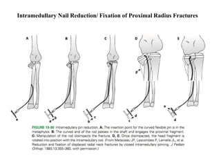 Intramedullary Nail Reduction/ Fixation of Proximal Radius Fractures
 