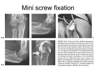 Mini screw fixation
 