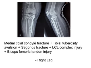 Medial tibial condyle fracture + Tibial tuberosity
avulsion + Segonds fracture + LCL complex injury
+ Biceps femoris tendon injury
- Right Leg
 