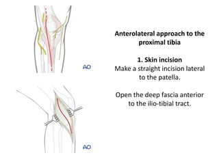 Anterolateral approach to the
proximal tibia
1. Skin incision
Make a straight incision lateral
to the patella.
Open the deep fascia anterior
to the ilio-tibial tract.
 