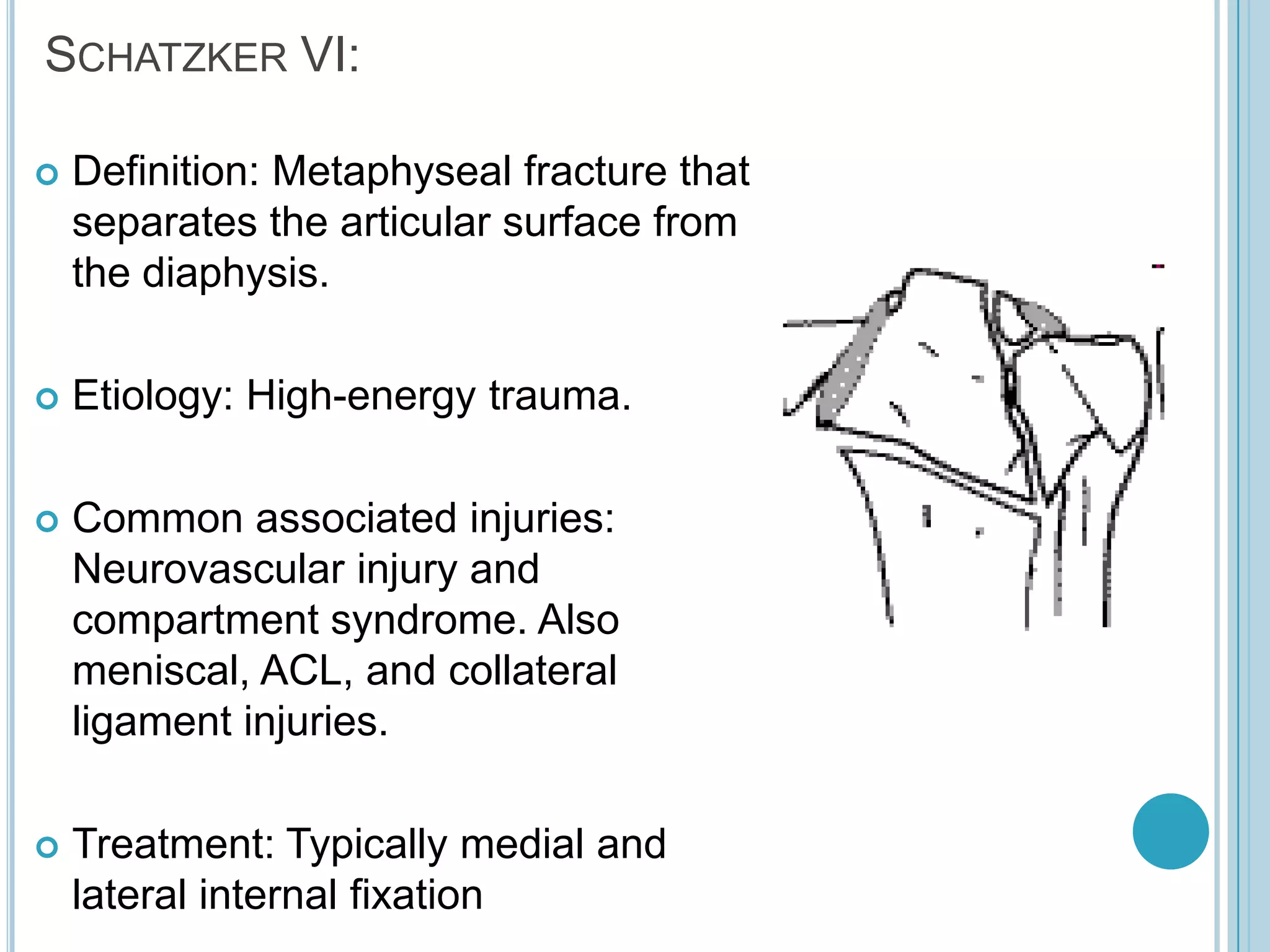 Proximal tibia fracture | PPTX