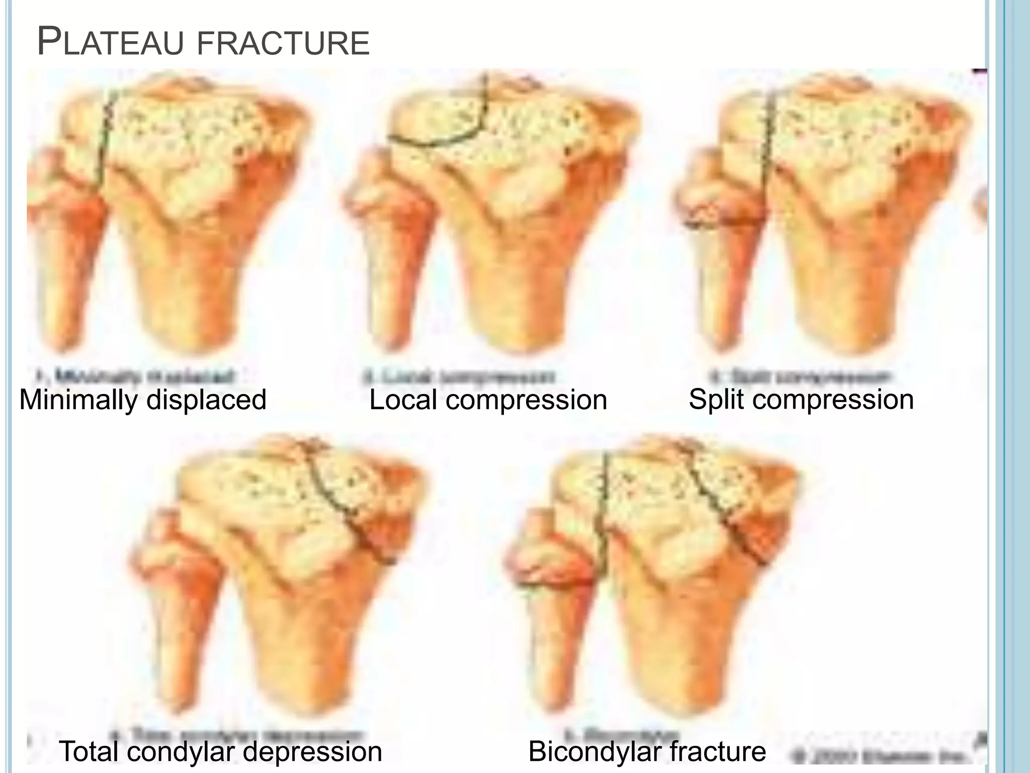 Proximal tibia fracture | PPTX