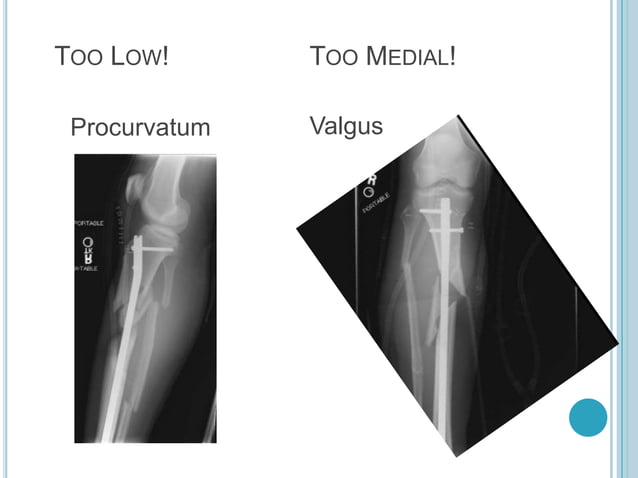 Proximal tibia fracture | PPTX