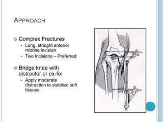 Complex Ribia Fracture Proximal tibia fracture | PPTX