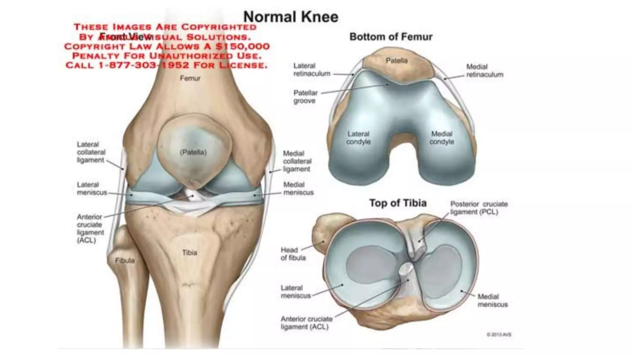 Proximal tibia fractures(Plateau, spine ,Tubercle and Epiphyseal ) | PPT