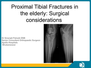 Dr Smarajit Patnaik DNB
Senior Consultant Orthopaedic Surgeon
Apollo Hospitals
Bhubaneswar
Proximal Tibial Fractures in
the elderly: Surgical
considerations
 