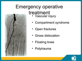 Proximal tibial fracture | PPT