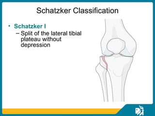 Scthker Classification Proximal tibial fracture | PPT