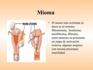 Mioma
   • El tumor más corriente es
     útero es el mioma;
     fibromioma, liomioma,
     miofibroma, fibroma,
     estos tumores se presentan
     en etapa de activación
     ovárica, algunas mujeres
     con mioma presentan
     esterilidad.
 