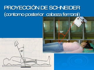 PROYECCIÓN DE SCHNEIDER ( contorno posterior  cabeza femoral) 30º 