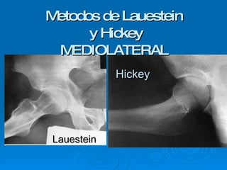 Metodos de Lauestein  y Hickey MEDIOLATERAL Lauestein Hickey 