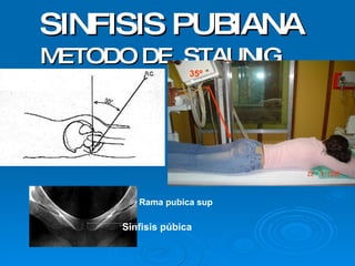 SINFISIS PUBIANA  METODO DE  STAUNIG 35º Rama pubica sup Sinfisis púbica 