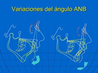 Variaciones del ángulo ANB 