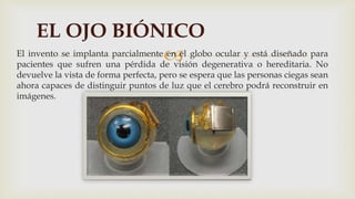 El invento se implanta parcialmente en el globo ocular y está diseñado para
pacientes que sufren una pérdida de visión degenerativa o hereditaria. No
devuelve la vista de forma perfecta, pero se espera que las personas ciegas sean
ahora capaces de distinguir puntos de luz que el cerebro podrá reconstruir en
imágenes.
EL OJO BIÓNICO
 