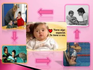 Que es el síndrome de DownEl síndrome de Down (SD) es un trastorno genético causado por la presencia de una copia extra del cromosoma 21 (o una parte del mismo), en vez de los dos habituales (trisomíadel par 21), caracterizado por la presencia de un grado variable de retraso mentaly unos rasgos físicos peculiares que le dan un aspecto reconocible. Es la causa más frecuente de discapacidadpsíquica congénita y debe su nombre a John Langdon Haydon Down que fue el primero en describir esta alteración genética en 1866, aunque nunca llegó a descubrir las causas que la producían