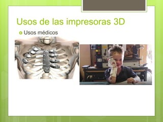 Usos de las impresoras 3D
 Usos médicos
 
