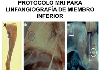 PROTOCOLO MRI PARA
LINFANGIOGRAFÍA DE MIEMBRO
INFERIOR
 