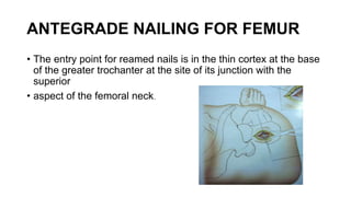 Cortexed Nail Intramedullary nailing.pptx