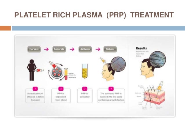 Platelet Rich Plasma (PRP) Hair Loss Treatment