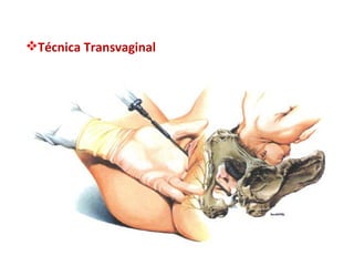 Técnica Transvaginal 