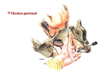 Técnica perineal 