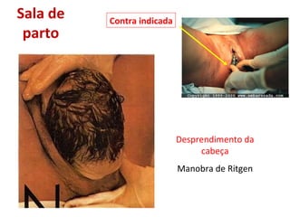 Sala de parto Desprendimento da cabeça Manobra de Ritgen Contra indicada 