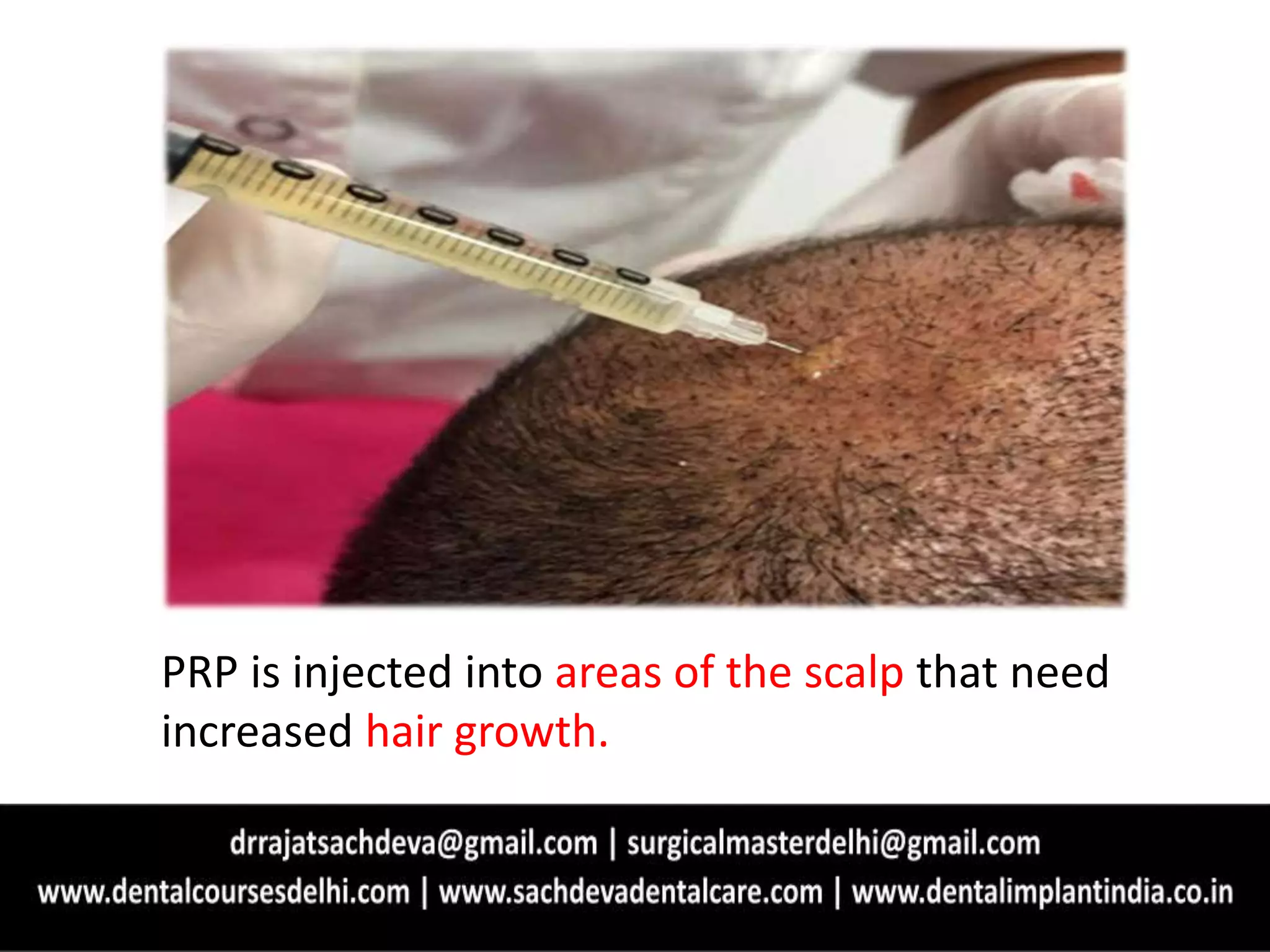 Prp for hair regrowth | PPTX