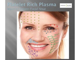 USE OF PLATELET RICH PLASMA IN AESTHETIC SURGERY | PPTX