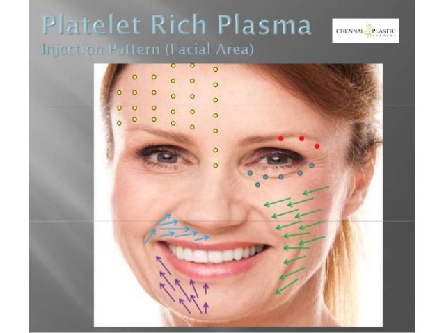 USE OF PLATELET RICH PLASMA IN AESTHETIC SURGERY