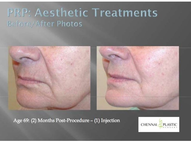 USE OF PLATELET RICH PLASMA IN AESTHETIC SURGERY