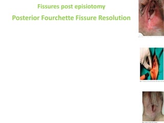 Fissures post episiotomy
Posterior Fourchette Fissure Resolution
 