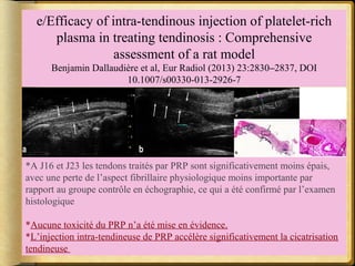 e/Efficacy of intra-tendinous injection of platelet-rich 
plasma in treating tendinosis : Comprehensive 
assessment of a rat model 
Benjamin Dallaudière et al, Eur Radiol (2013) 23:2830–2837, DOI 
10.1007/s00330-013-2926-7 
*A J16 et J23 les tendons traités par PRP sont significativement moins épais, 
avec une perte de l’aspect fibrillaire physiologique moins importante par 
rapport au groupe contrôle en échographie, ce qui a été confirmé par l’examen 
histologique 
*Aucune toxicité du PRP n’a été mise en évidence. 
*L’injection intra-tendineuse de PRP accélère significativement la cicatrisation 
tendineuse 
 