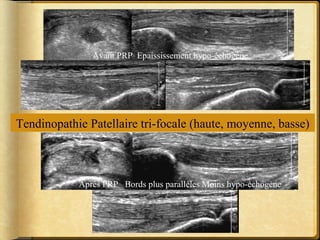 Avant PRP Epaississement hypo-échogène 
Tendinopathie Patellaire tri-focale (haute, moyenne, basse) 
Aprés PRP Bords plus parallèles Moins hypo-échogène 
 