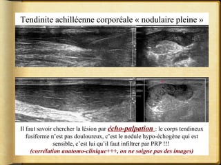 Tendinite achilléenne corporéale « nodulaire pleine » 
Il faut savoir chercher la lésion par écho-palpation : le corps tendineux 
fusiforme n’est pas douloureux, c’est le nodule hypo-échogène qui est 
sensible, c’est lui qu’il faut infiltrer par PRP !!! 
(corrélation anatomo-clinique+++, on ne soigne pas des images) 
 