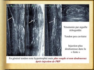 Ténotomie par aiguille 
échoguidée 
Tendon peu cavitaire 
Injection plus 
douloureuse dans la 
« fente » 
En général tendon reste hypertrophié mais plus souple et non douloureux 
Après injection de PRP 
 