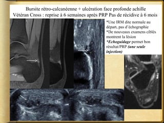Bursite rétro-calcanéenne + ulcération face profonde achille 
Vétéran Cross : reprise à 6 semaines après PRP Pas de récidive à 6 mois 
*Une IRM dite normale au 
départ, pas d’échographie 
*De nouveaux examens ciblés 
montrent la lésion 
*Echoguidage permet bon 
résultat/PRP (une seule 
injection) 
 