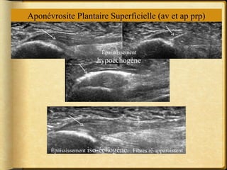 Aponévrosite Plantaire Superficielle (av et ap prp) 
Épaississement 
hypoéchogène 
Épaississement iso-échogène Fibres ré-apparaissent 
 